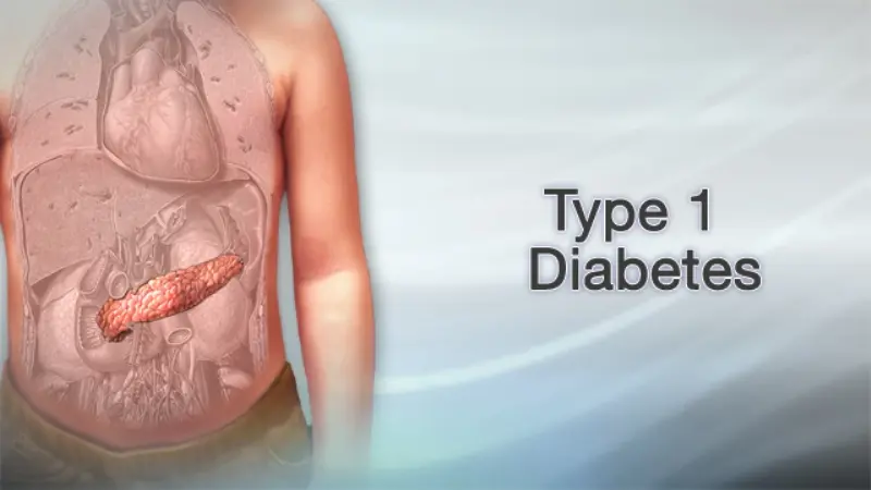 Understanding Type 1 Diabetes: A Comprehensive Overview